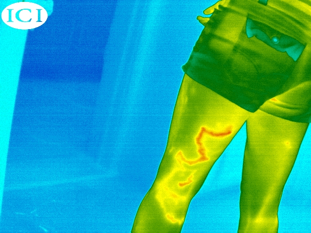 9640-p-series-thermal-infrared-image-show-vein-in-leg-1