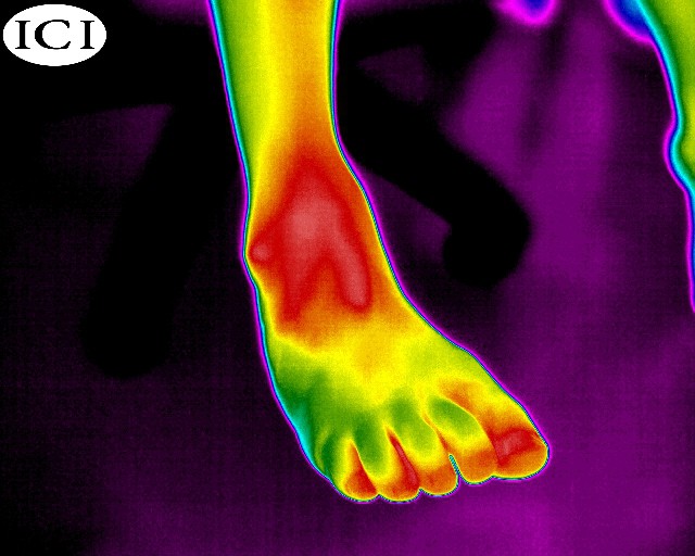 FX-640-Medical-infrared-image-of-mans-ankle-and-foot-1