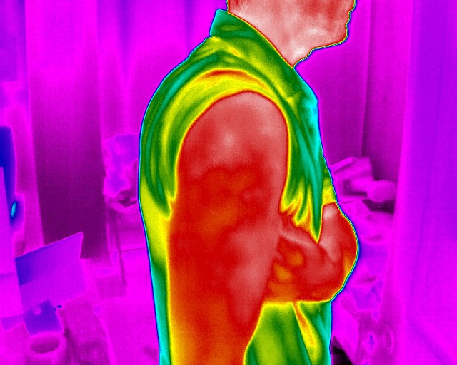 FX-640-Medical-infrared-image-of-shoulder-injury-1