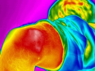 FX-640-Medical-infrared-image-shows-Cerebral-Palsy-1